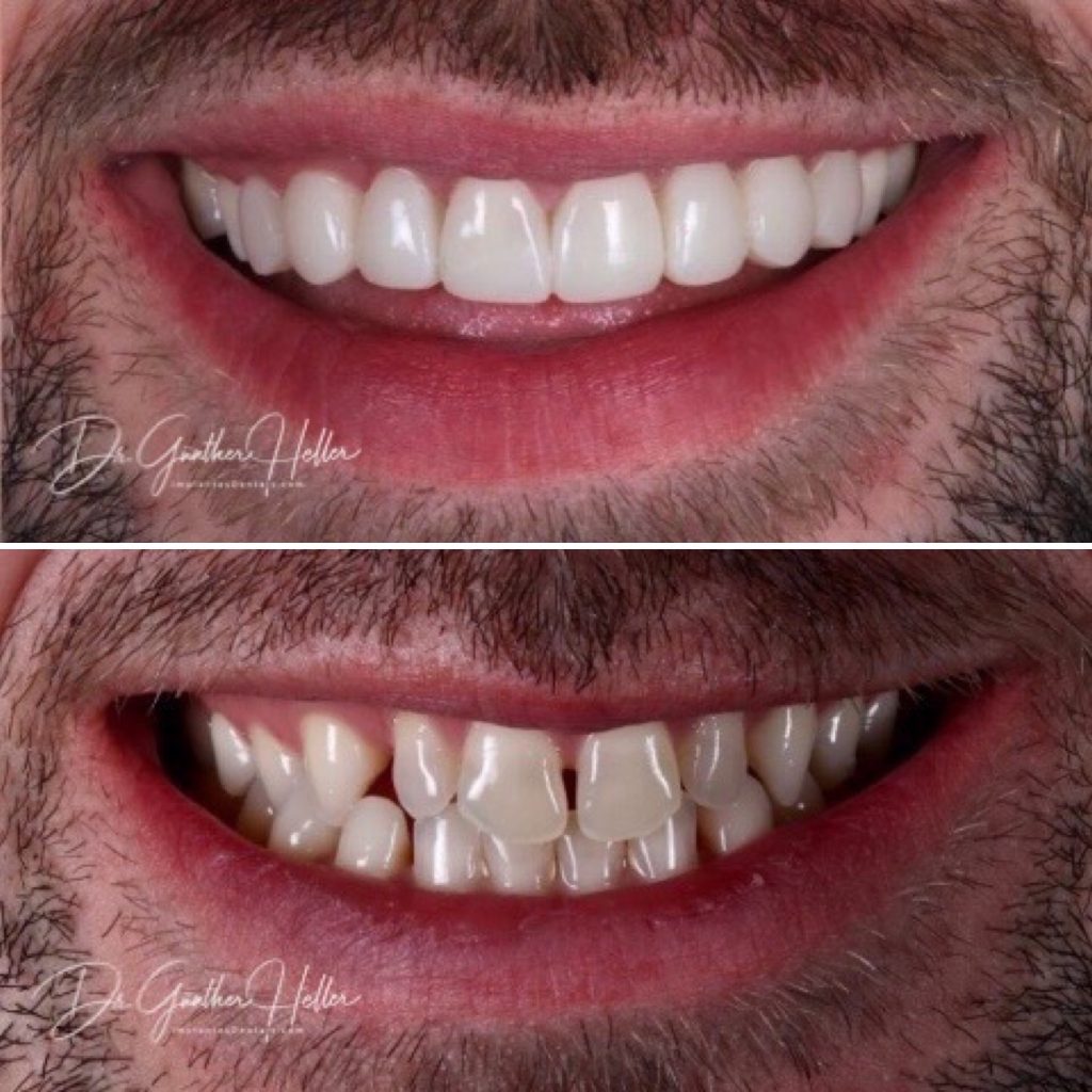 ClearCorrect ou Invisalign